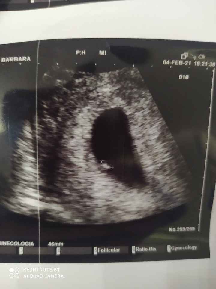 Embrione piccolo 6+6 settimane - 1