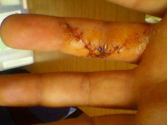 15 punti di sutura e vite