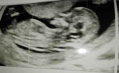 ecografia 12 settimane