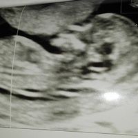 ecografia 12 settimane