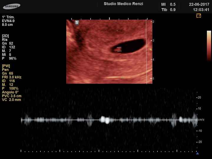  Prima ecografia - 1