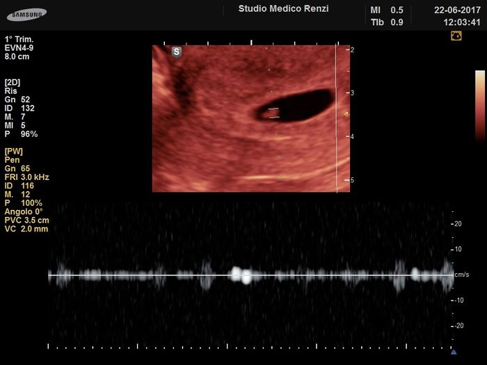 Prima ecografia 3
