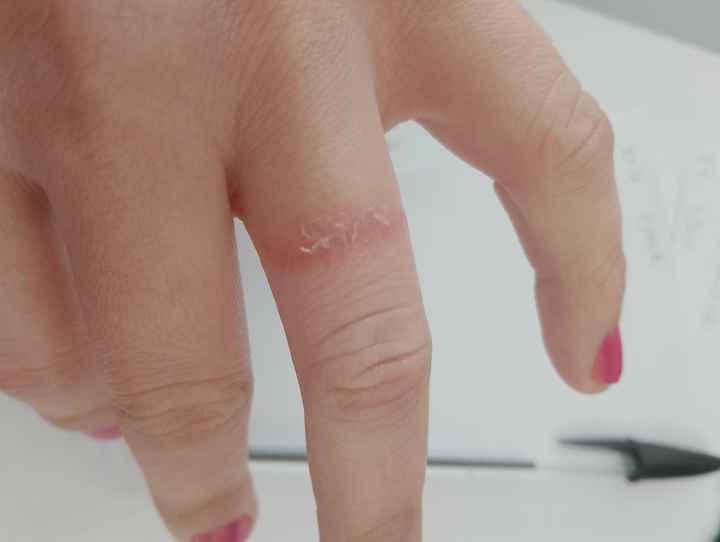 Allergia alla....fede nuziale! - 1