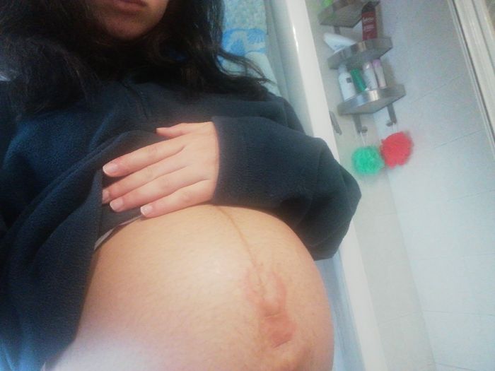 Smagliature e prurito insopportabile! Aiuto! 2