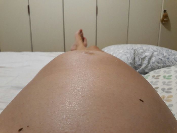 Diastasi addominale ( bozzo sull addome) 1