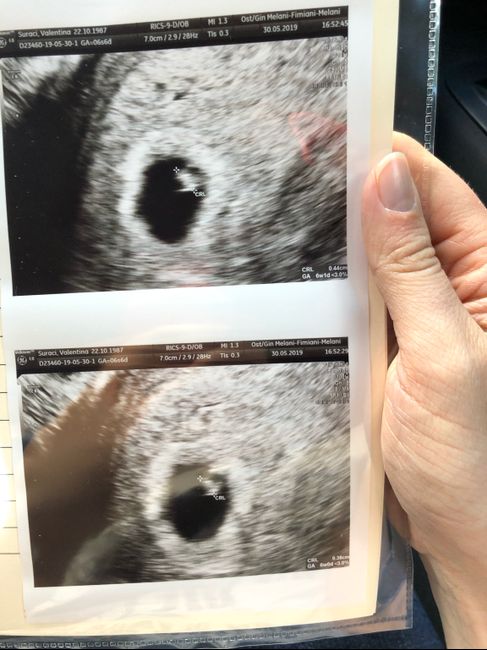 6 settimane e inizio dei dolori 1