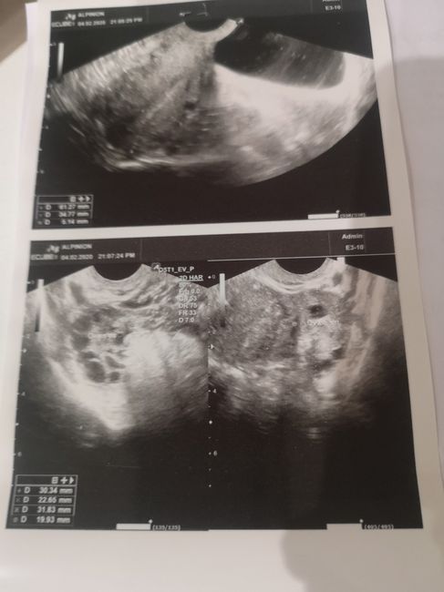 Test ovulazione e ovaie multifollicolari - 2