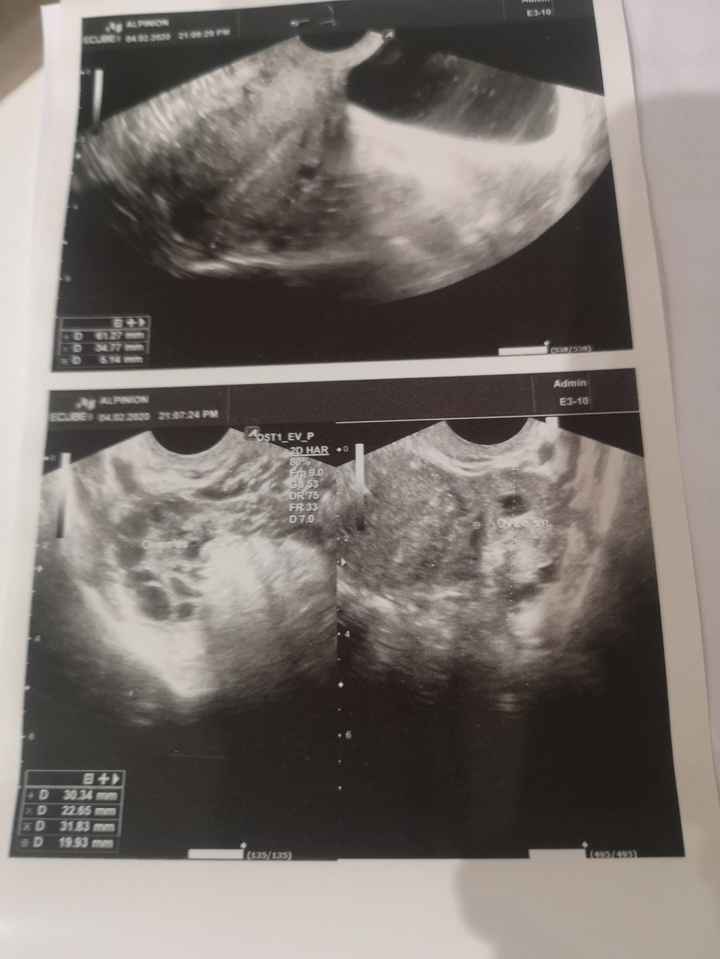 Test ovulazione e ovaie multifollicolari 3