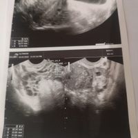 Test ovulazione e ovaie multifollicolari - 2