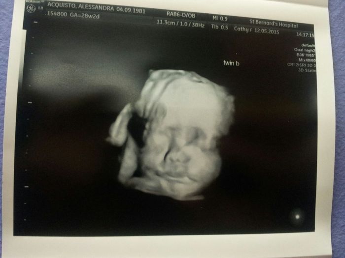 baby twin girl 28 weeks