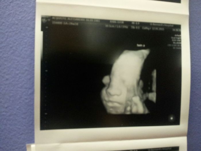 baby twin boy 28 weeks