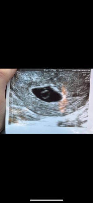 6 settimane e niente embrione!! 1