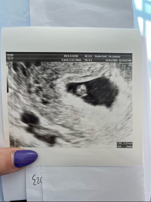 6 settimane e niente embrione!! 1