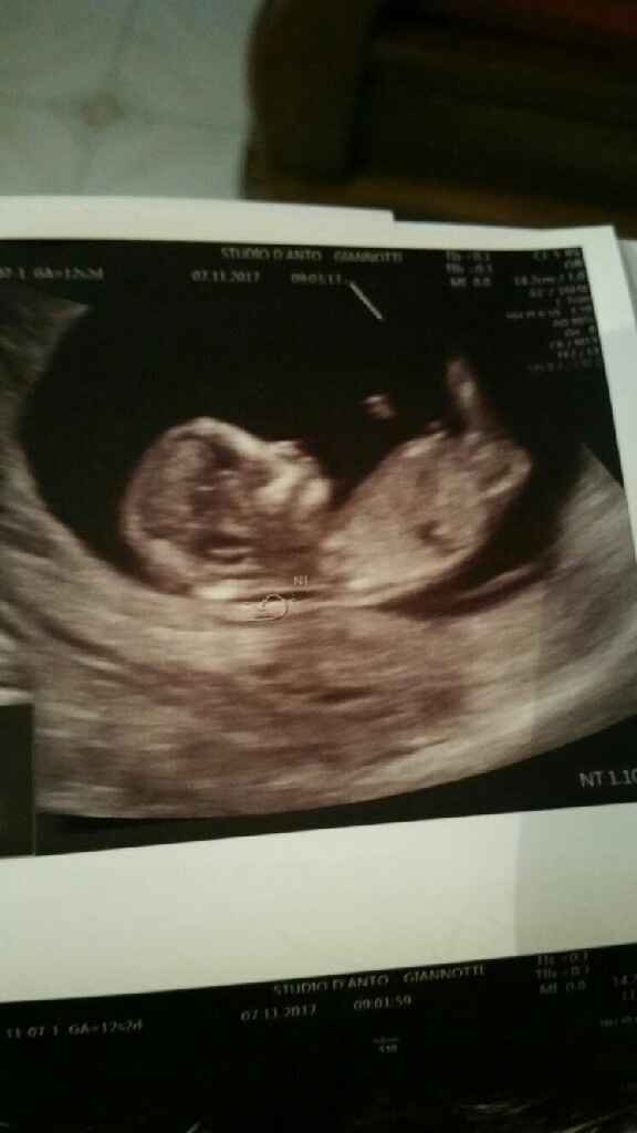  Trasnucenza nucale - 1