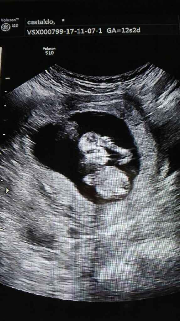  Trasnucenza nucale - 3