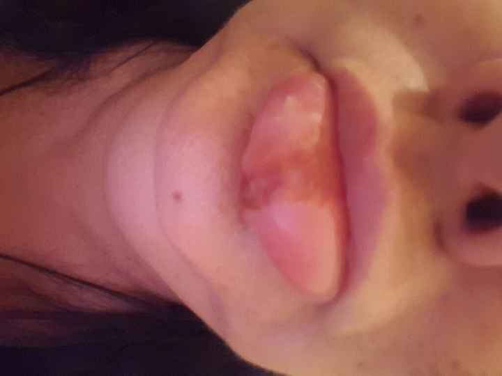 Herpes - 1