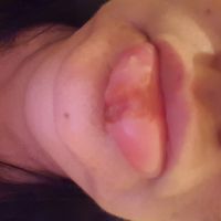 Herpes - 1