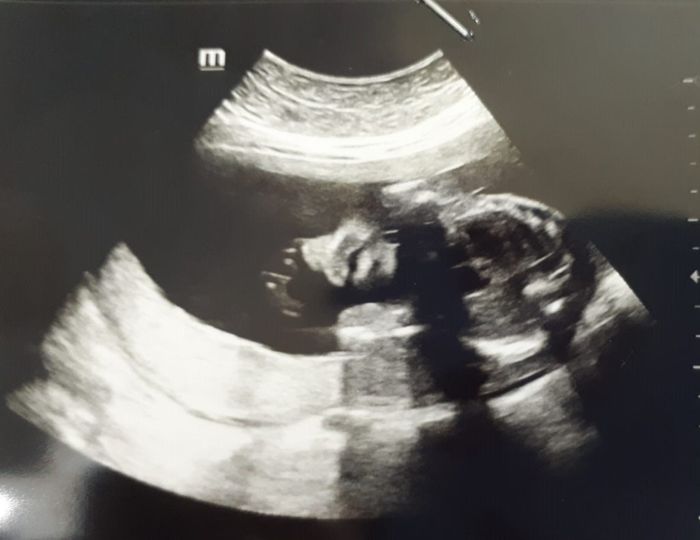 Ecografia 23+5