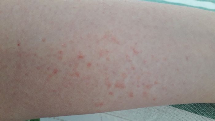 Info colestasi gravidica!!! 1