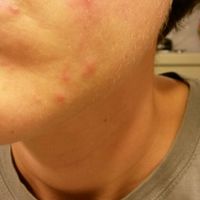 A -20 mi sto riempendo di bolle!! - 1