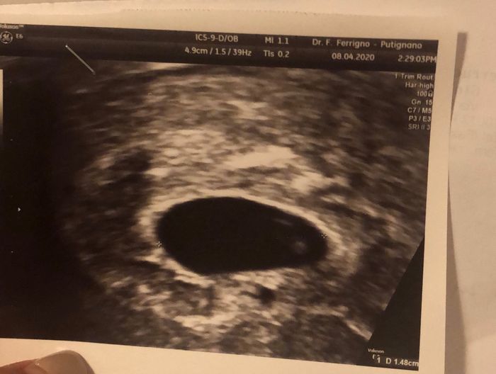 Perdite marroni e sacca vuota - 1