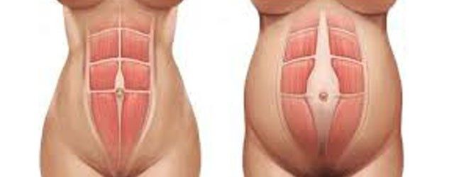 Diastasi addominale ( bozzo sull addome) - 2