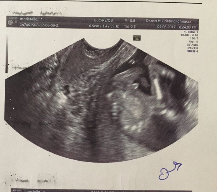 14+1 ecografia - 1