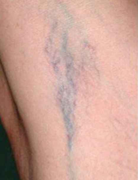 Vene varicose e gonna: integratori o altre soluzioni? - 1