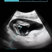 Ecografia con sesso evidente - 2
