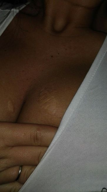 Problema cicatrice - 1