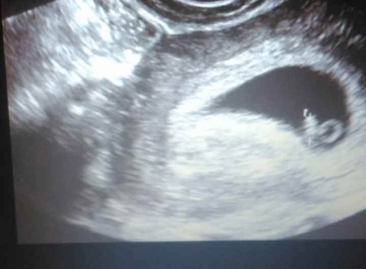 Prima ecografia
