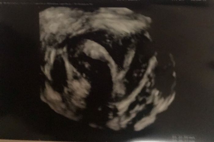 Utero setto chi come me??! 1