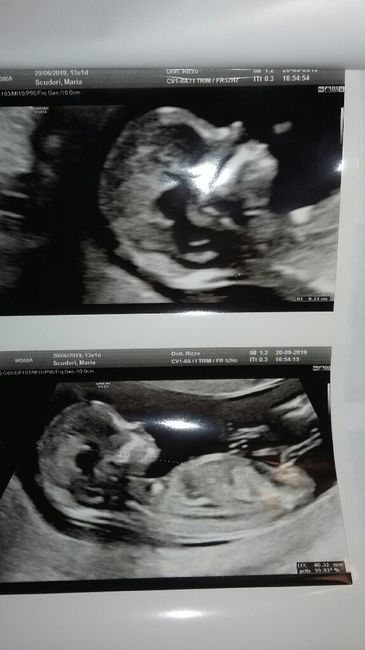 Esiti screening primo trimestre e bi test - 4