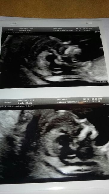 Esiti screening primo trimestre e bi test 4