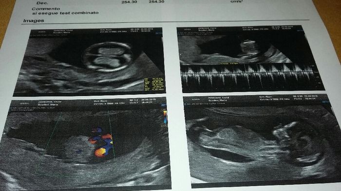 Ecografia translucenza nucale - 2