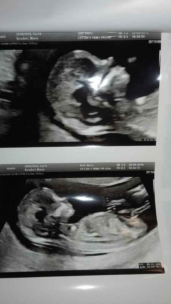 Esiti screening primo trimestre e bi test - 4