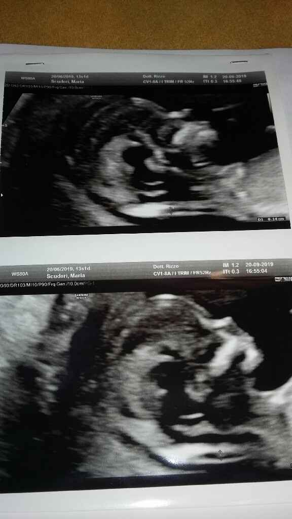 Esiti screening primo trimestre e bi test - 5