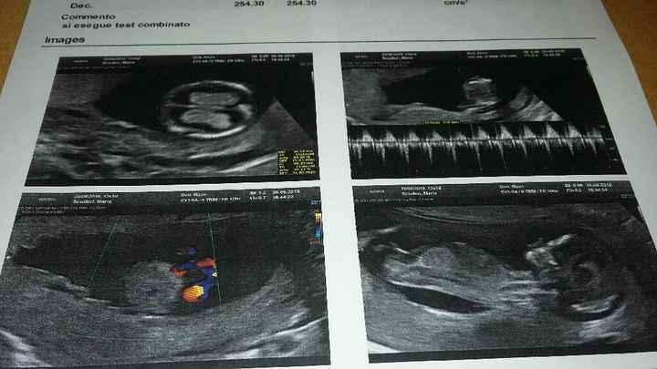 Ecografia translucenza nucale - 2