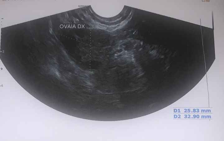 Interpretare eco ginecologica?! - 2