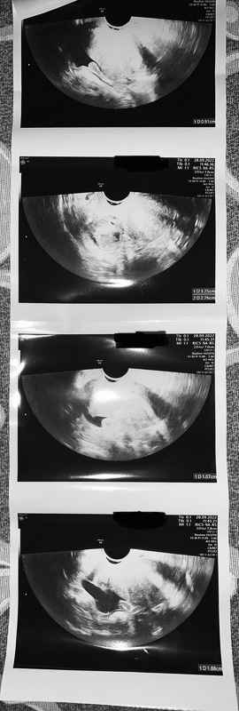 Eco ovulazione, sapreste aiutarmi a leggerla? Grazie 😔 - 1
