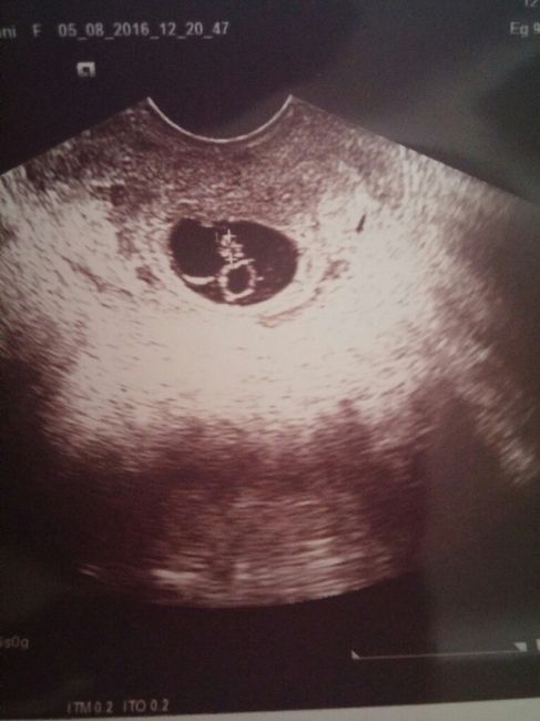 Prima ecografia... dubbi - 1