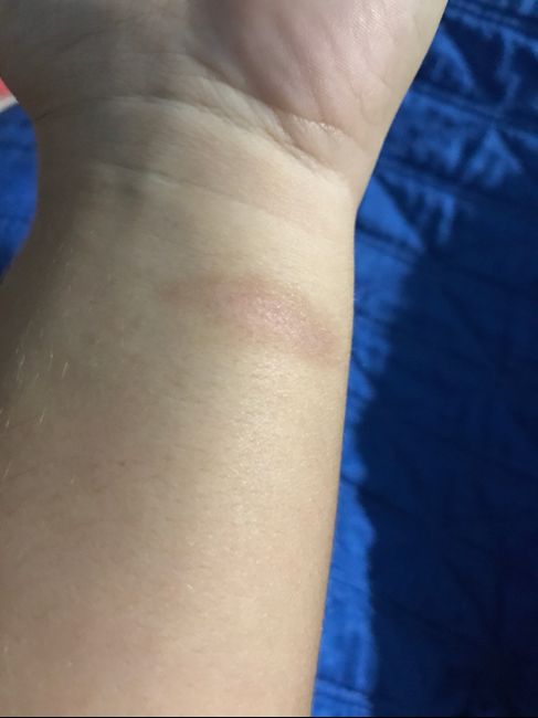 A giugno mi sono bruciata le mani! - 1