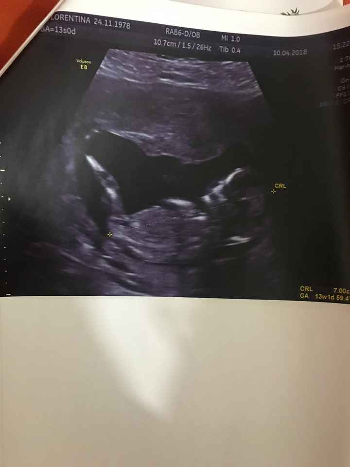 Traslucenza  e l'esame del dna fetale! - 1