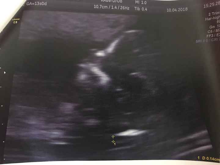 Traslucenza  e l'esame del dna fetale! - 2