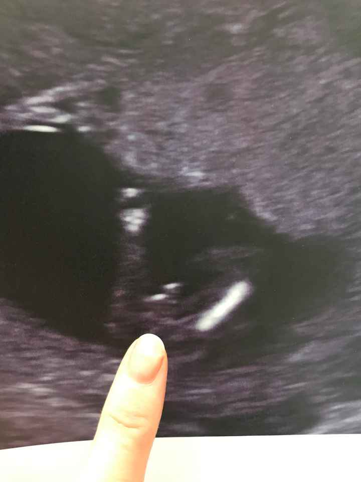 Sesso bambino con test dna - 1