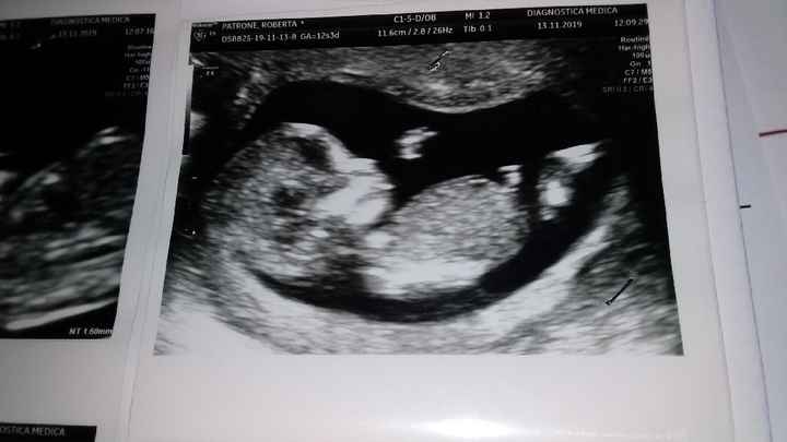 Translucenza nucale - 1