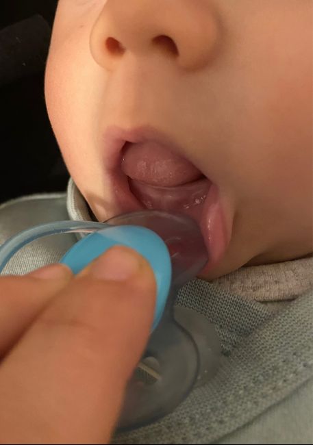 Sintomi inizio dentini!! 1