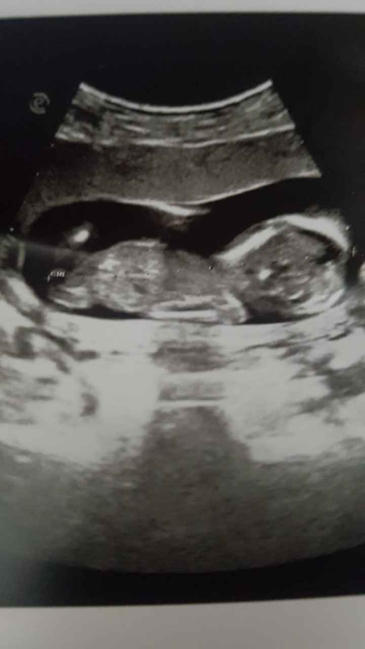 Ecografia,. Maschio o femmina? - 2