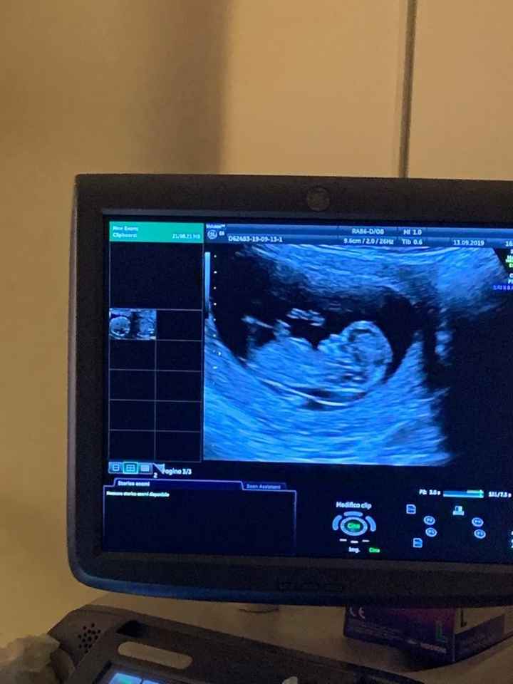 Traslucenza nucale alta - 1