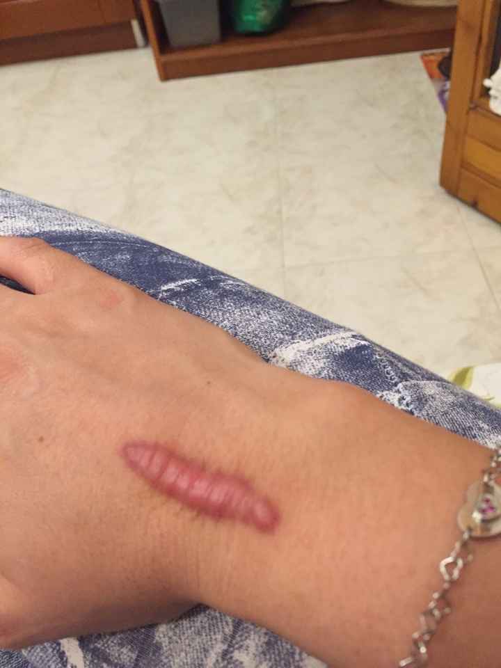 Problema cicatrice - 1